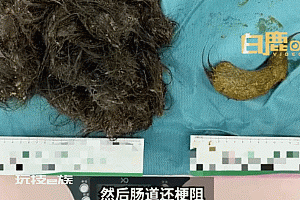 女孩薅头发吃下胃里取出5斤毛球  医生:异食癖