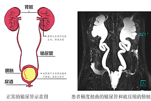 19岁小伙肚子患罕见疾病 一堆脂肪体重却暴跌至48公斤