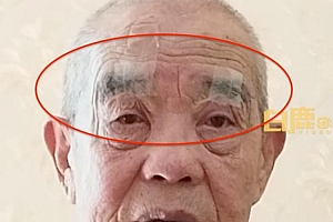 奶奶用胶带帮老伴提拉下垂眼皮!孙女:眼睛确实大了