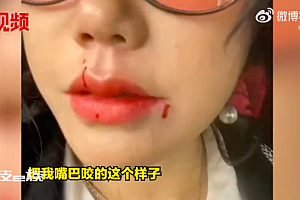 女子花钱救狗反被咬网友说活该 当事人:不后悔狗的本能反应而已