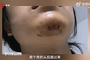 女子溜冰被人推倒下巴缝十多针 网友:看着都疼