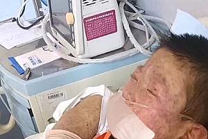 13岁男孩患怪病皮肤发黑浑身奇痒:原发性免疫缺陷