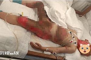 4岁女童趴火盆取暖深3度烧伤恐无法生育