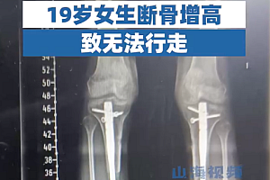 19岁女生断骨增高后无法行走!断骨增高四个字听起来不可怕吗