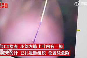 患者胸痛1个月肺里取出1根针 此外针灸很容易刺破肺部