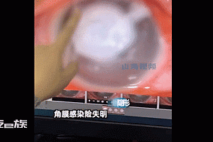 男子新婚夜忘摘隐形眼球变白:已变成瓷白色