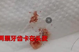 男子打球6天后发现头顶卡对手2颗牙 他们在我脑袋里住了一个星期直到散发腐臭味