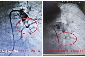 阳性一个月后肺栓塞风险增加33倍 医生:适当运动多饮水