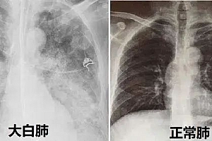 出现“白肺”怎么治?专家解答,及时就诊是关键