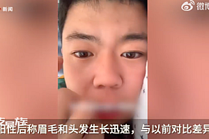 小伙阳后眉毛头发迅速增长 网友:去看看内分泌科室吧!