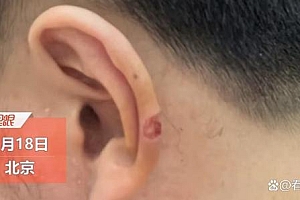 男子理发时耳朵被剪掉一块肉 理发店表示只赔200元