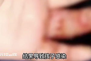 医生:烫伤后不要用冰块冷敷创面   常见误区一定要注意