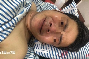 被骗至缅甸做电诈小伙回国 欠债20万,逃跑时手腿粉碎性骨折