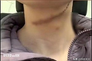 张家界女子被割喉嫌犯仅被拘十天?警方回应:鉴定伤情