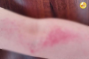 男子接触碎体温计水银致狒狒综合征:诱发因素水银位列第一