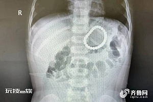 2岁幼童误吞28颗磁力珠 肚子疼哭闹 胃镜手术取出