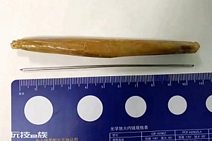 男子吃肉串误吞铁钎子强忍20天:误将长长铁钎吞下