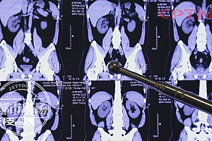 可乐“惹的祸”!程序员20年喝近2吨可乐多处器官屡患结石