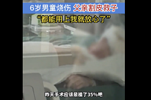 男童烧伤父亲割皮救子  一句“能用上就放心了”让人泪崩
