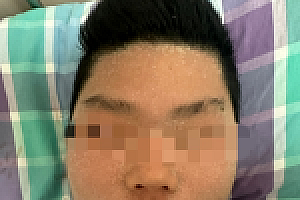 男生吃芒果过敏全身溃烂 网友:好像中毒了…