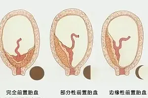 25岁女子怀孕8个月却浑然不知,一查竟是……极其凶险!