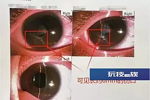 心疼!男孩帮妹妹换纸尿裤,意外被划破眼球