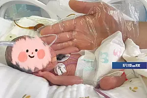 体重仅1斤多!巴掌大小!合肥一医院紧急救治早产双胞胎