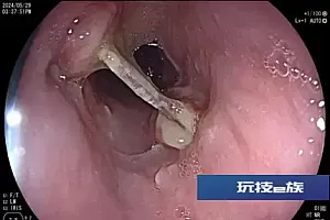 一次性塑料碗碎片在食管里待了3个月,女子食管溃烂接受手术