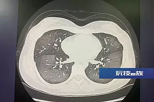 防晒喷雾用不对,小心“白肺”了!专家支招:这样用才对!