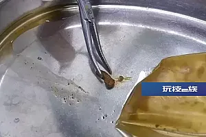 手术后金属夹滞留体内?漳州八旬老人腹痛难忍!医院回应