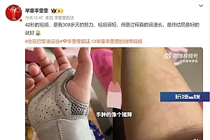 李雯雯晒手肿视频,自言“像猪蹄”