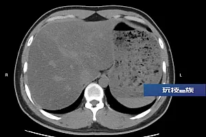 “怎么可能!”宁波29岁女子吃素半年,到医院一查,傻眼!很多人都错了……