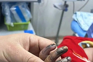 手指瞬间烧黑,1岁宝宝被紧急送医,曾有多人中招