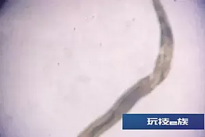 吓人!昆明一患者眼内取出1.5厘米长活虫!医生提醒