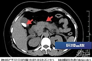 一口气干掉4只,杭州女子连夜抢救!医生提醒:餐桌上有这道菜的注意了