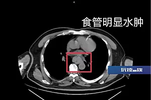 一口烫肿食管,男子吐血休克!“趁热吃”可能致癌