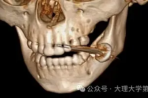 2岁孩子将电池放嘴里咬发生爆炸,云南医生完整取出碎屑