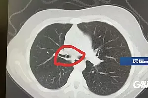 危险,家长注意!一10岁女孩剧烈咳嗽,不是肺炎,而是异物被误吸入气管内!