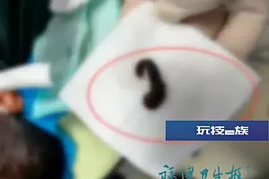 男子反复流鼻血,医生一查傻眼:取出一整条水蛭