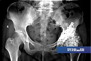 密密麻麻,女子体内取出近300颗软骨瘤