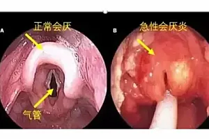 26岁女子从紧急就诊到去世仅10分钟!这种病千万别以为是上火了