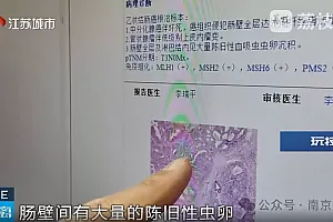 结肠出现巨大肿块,肠壁有虫卵!61岁男子头晕乏力误以为贫血发作!