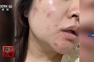 “针清”后痘痘不减反增 这些祛痘法操作不当可能会“烂脸”