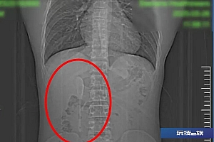 15cm咖啡勺被遗忘腹中半年!上海男子对此毫无记忆,直至回溯起一场“梦境”般的经历